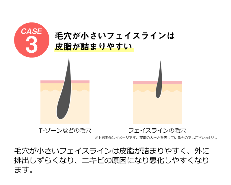 ケース3 毛穴が小さいフェイスラインは皮脂が詰まりやすい